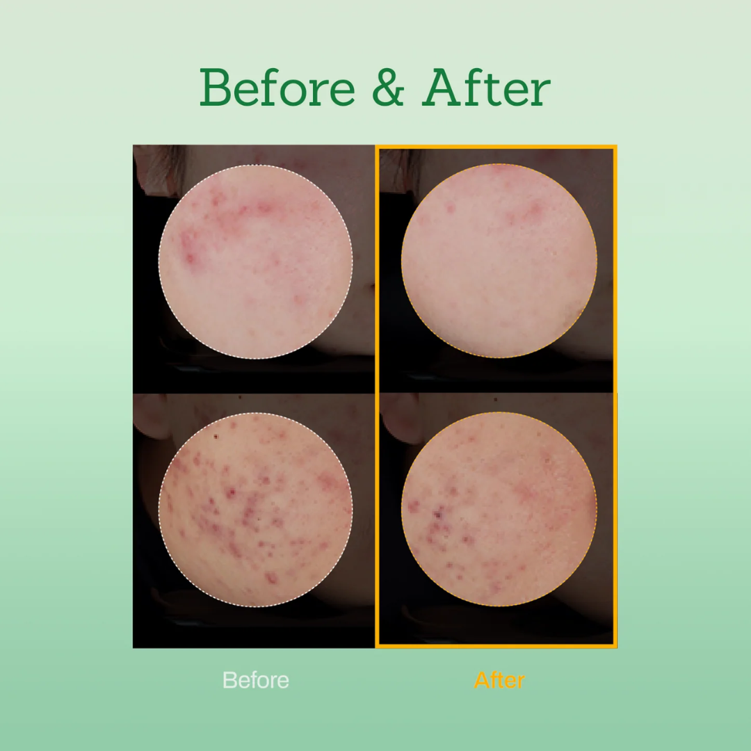 Orien Soothing Spray Toner for Spotless Skin - Removes Acne, Fades Dark Spots, Reveals Glow