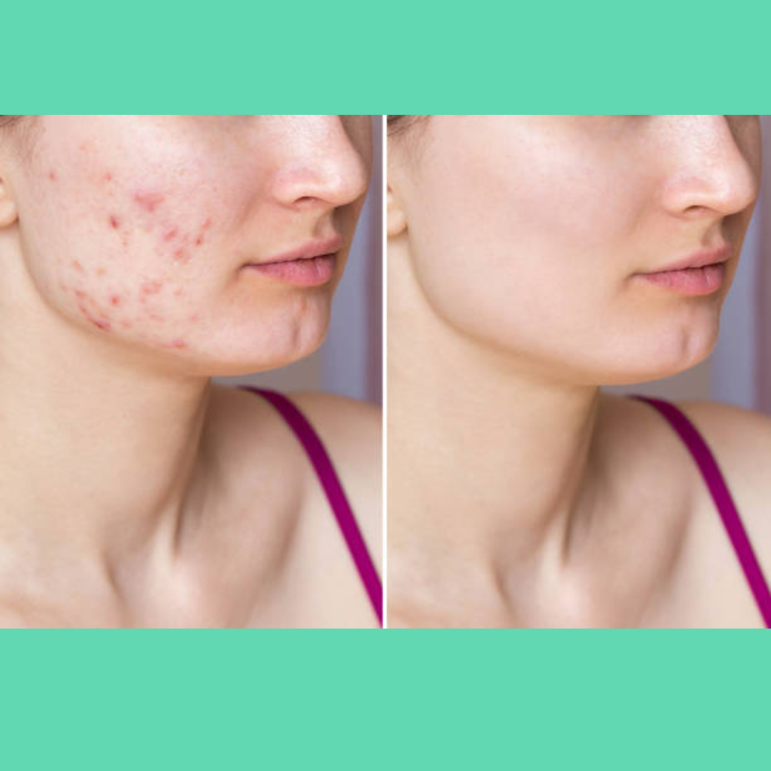 AcneSquad Acne Defense Spot Corrector | Clears Pimples, Kills Acne Bacteria & Fades Dark Spots