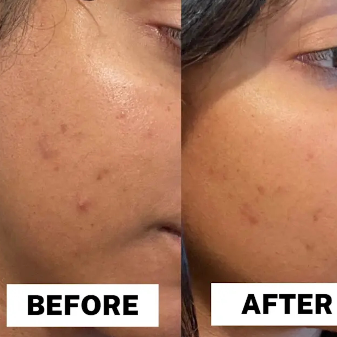 AcneSquad Acne Defense Spot Corrector | Clears Pimples, Kills Acne Bacteria & Fades Dark Spots