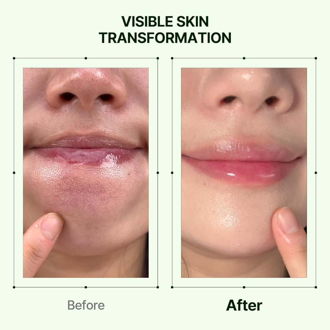 Orien Soothing Spray Toner for Spotless Skin - Removes Acne, Fades Dark Spots, Reveals Glow